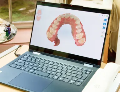 iTeroによる治療前後の歯並びをシミュレーション