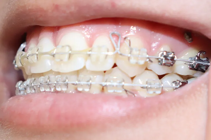 大人の矯正治療